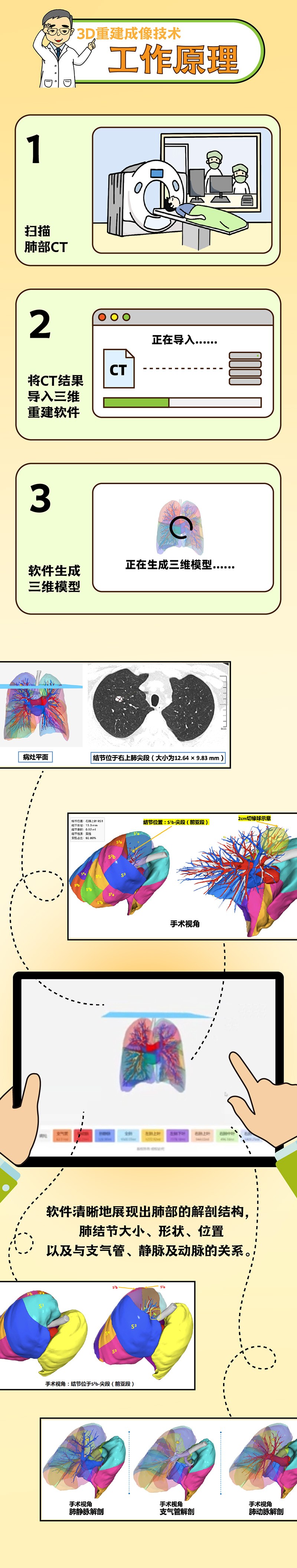 肺結節小劇場(chǎng) vol10 ｜3D重建成像技術(shù)——助力微創(chuàng  )精準切除